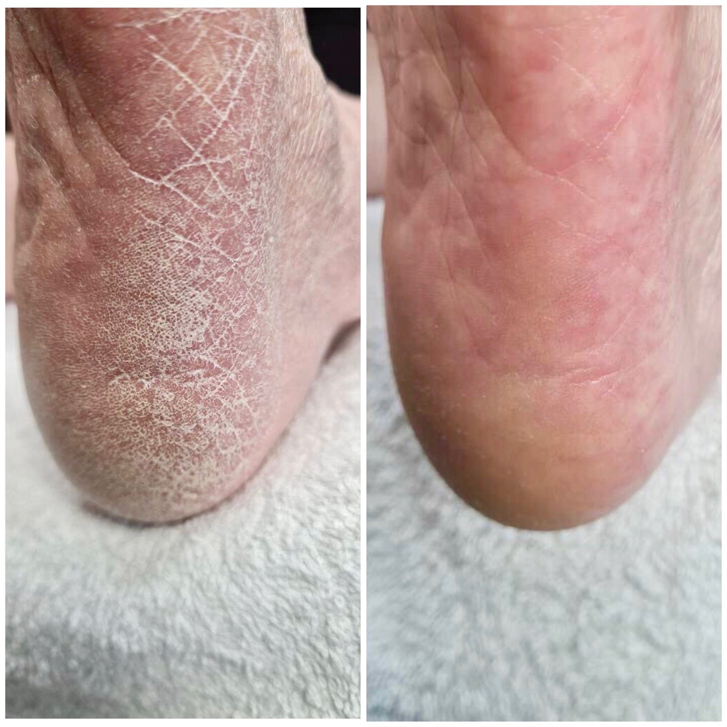 Kit de démarrage LOVASKIN INSTANT FOOT PEEL