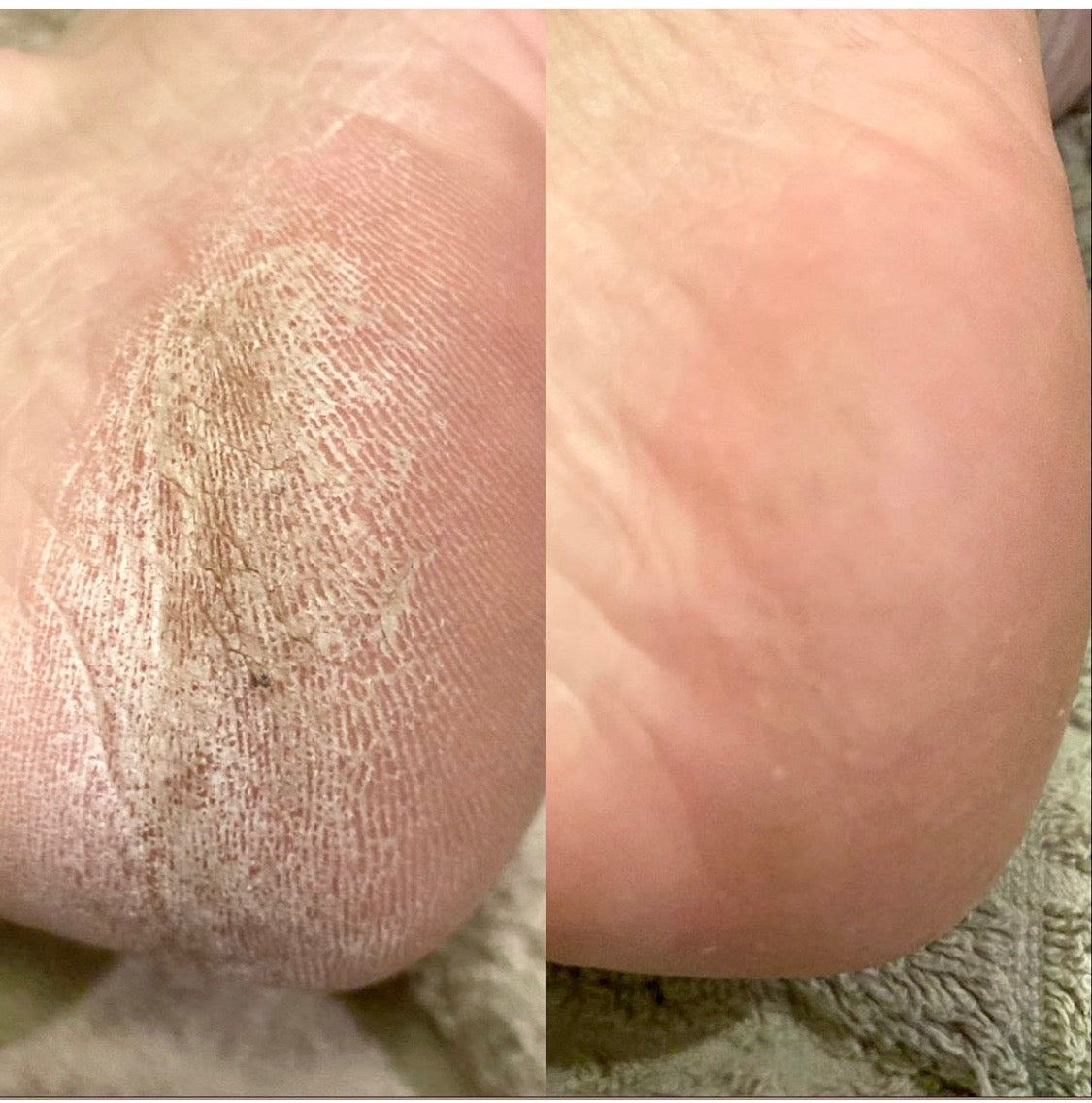 LOVASKIN INSTANT FOOT PEEL - Flacon pulvérisateur 75 ml - 25 traitements dans un seul flacon