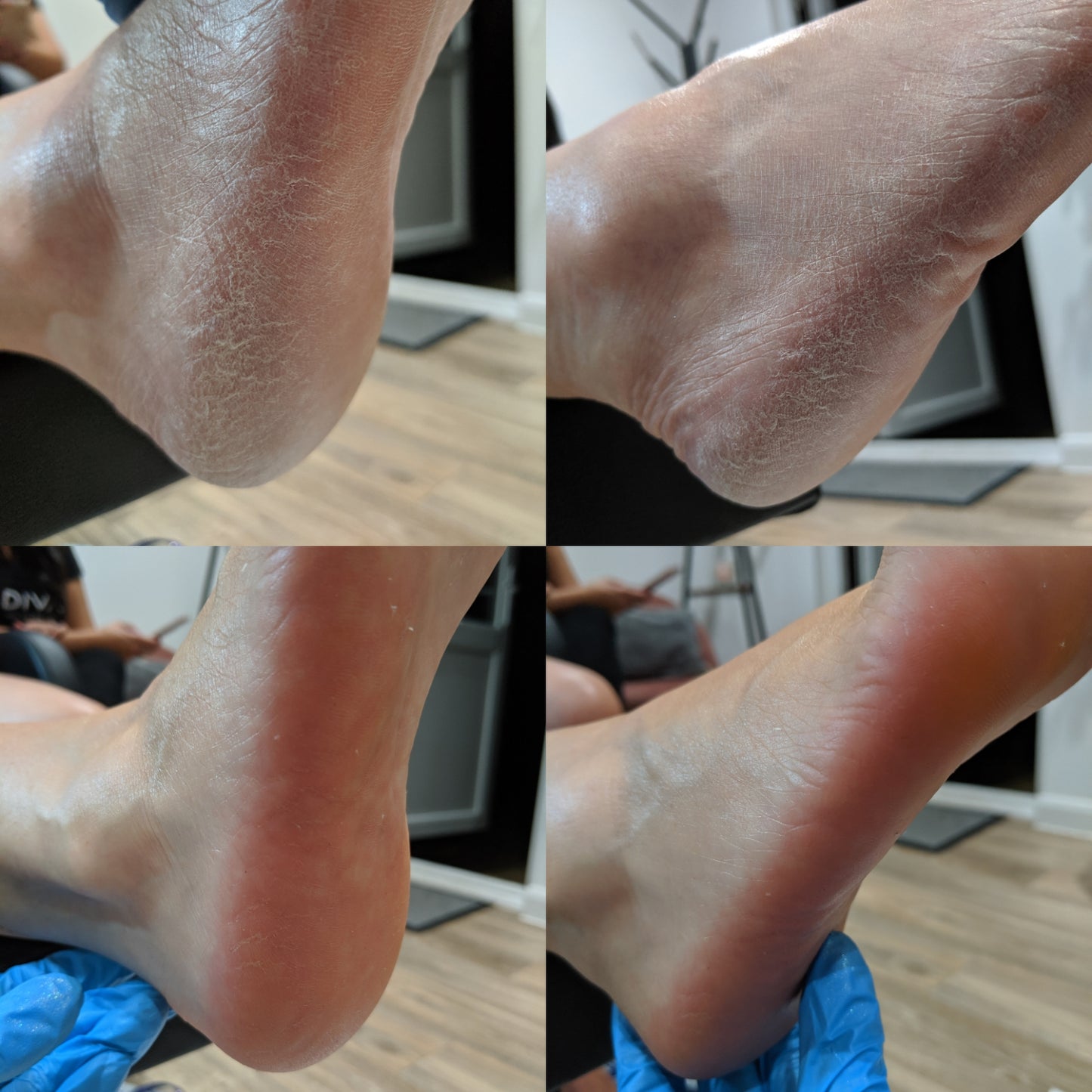 LOVASKIN ESSENTIAL DUO XL - Recharge Peeling Instantané pour les Pieds 250 ml et Hydratant Instantané 250 ml